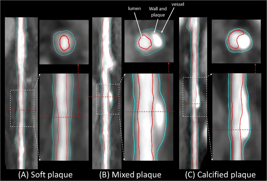 Cardiac imaging study found plaque in 34.6% of men in their 30s